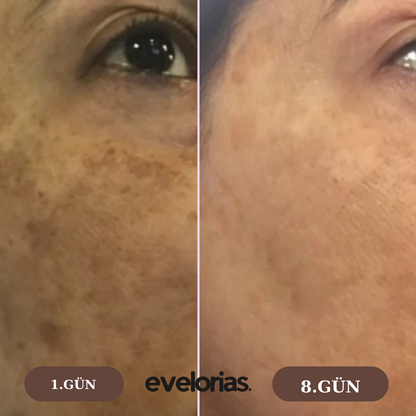 Evelorias™ - Kojic Asid Ped