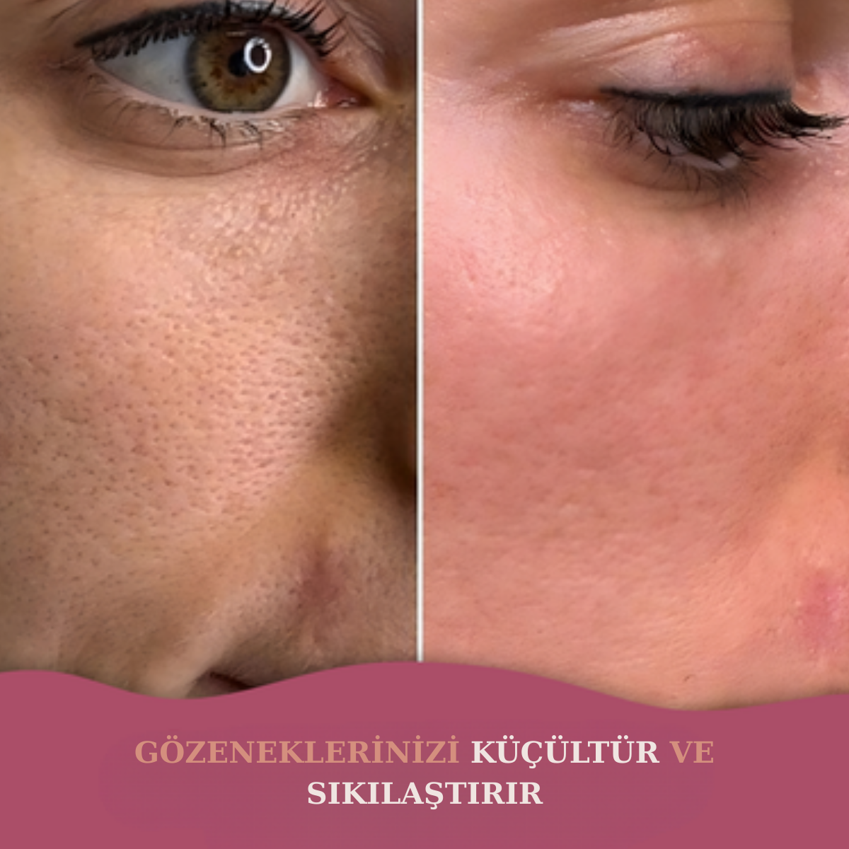 Evelorias™ - Kojic Asid Ped