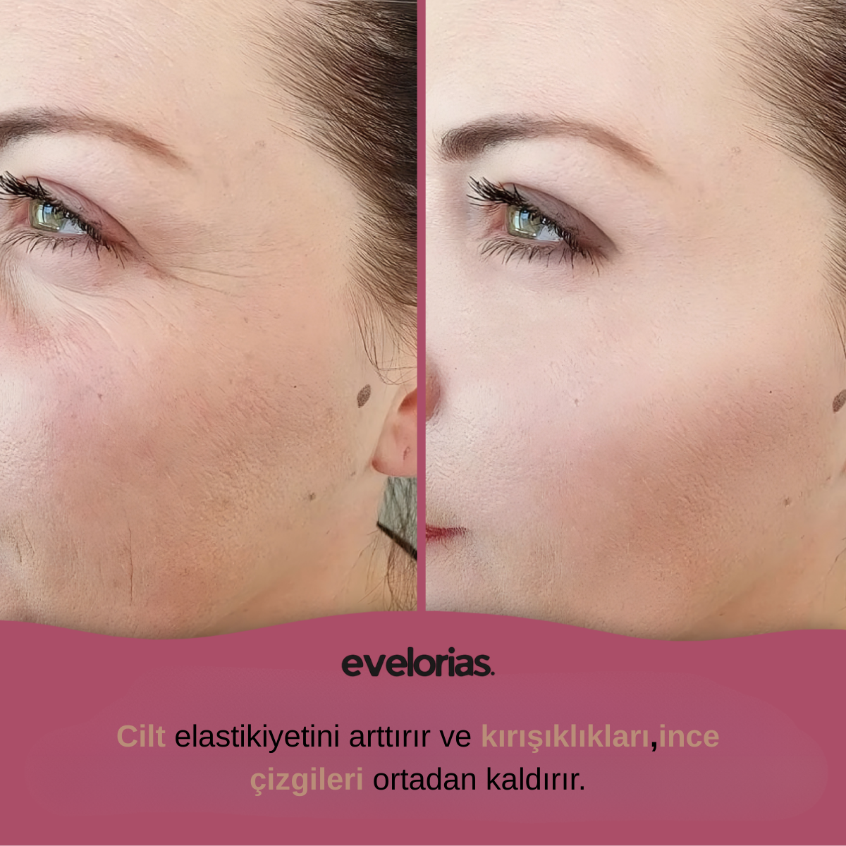 Evelorias™ - Kojic Asid Ped