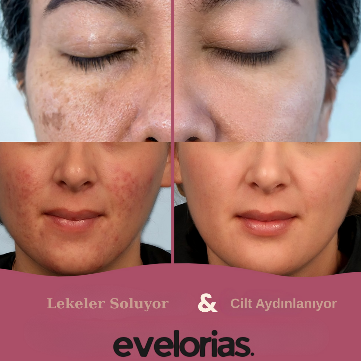 Evelorias™ - Kojic Asid Ped